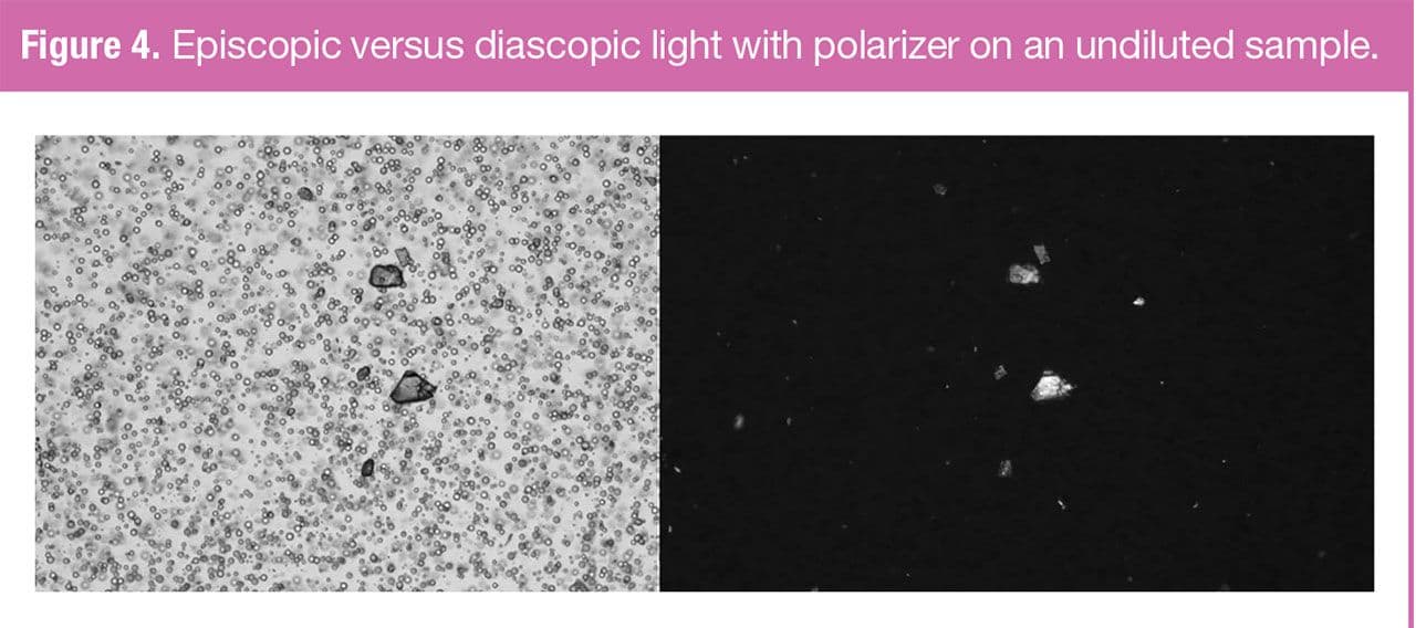 Figure 4. Episcopic versus diascopic light with polarizer on an undiluted sample. (Figure courtesy of the author)