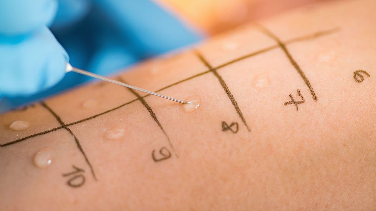 Skin Prick Allergy Testing |Image Credit: © Microgen - © Microgen - stock.adobe.com